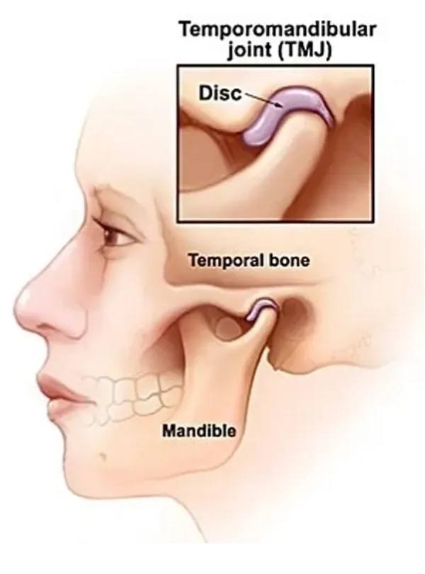Temporomandibular Joint Disease
